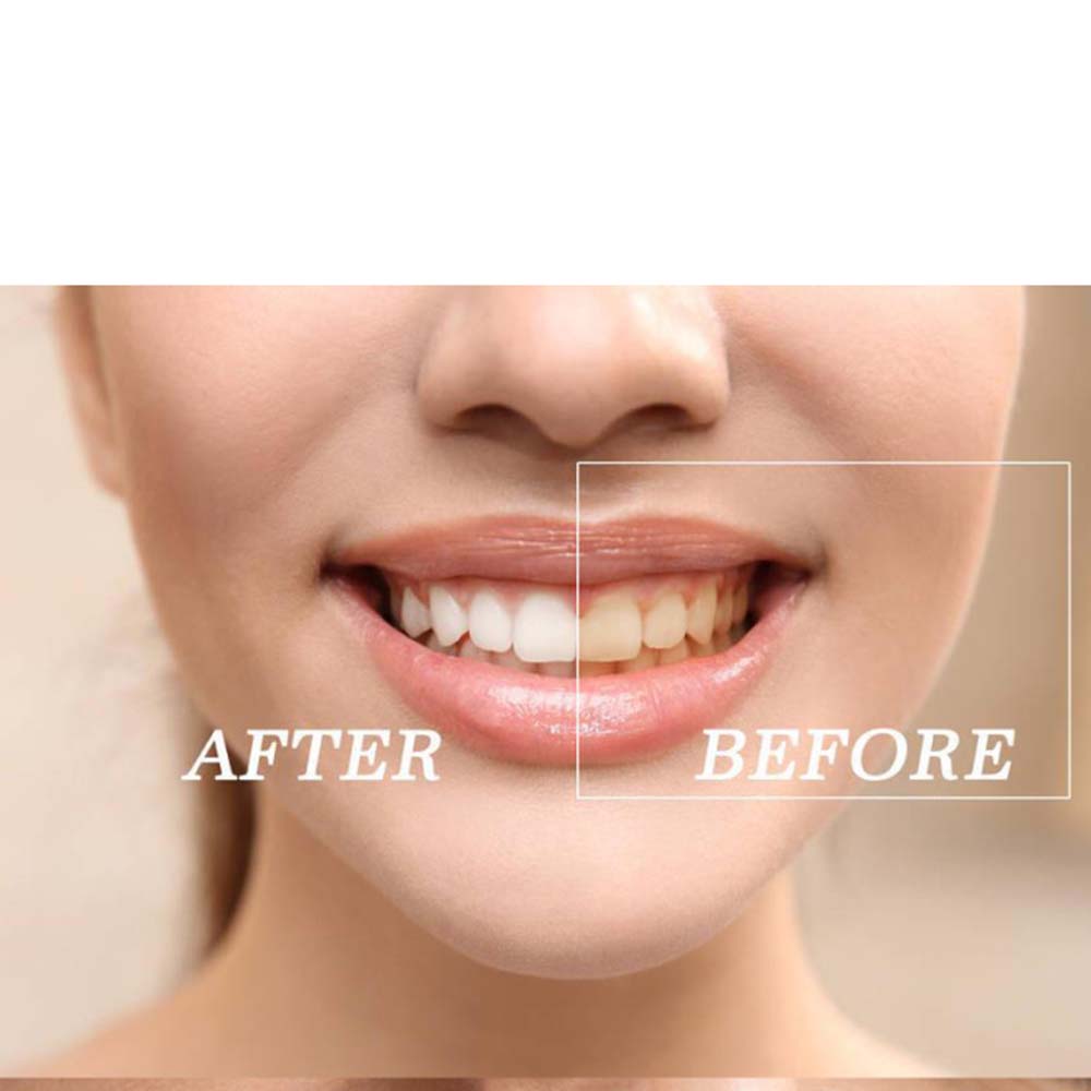 Kit Gel pemutih gigi peroksida - Teeth Whitening (Bleaching) ulasan dan harga
